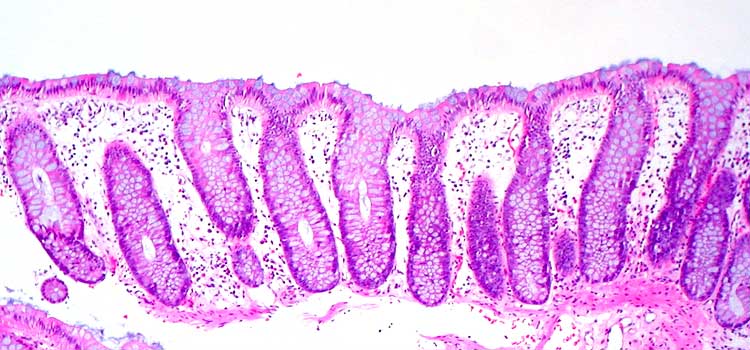 remedios caseros para la colitis prevenir