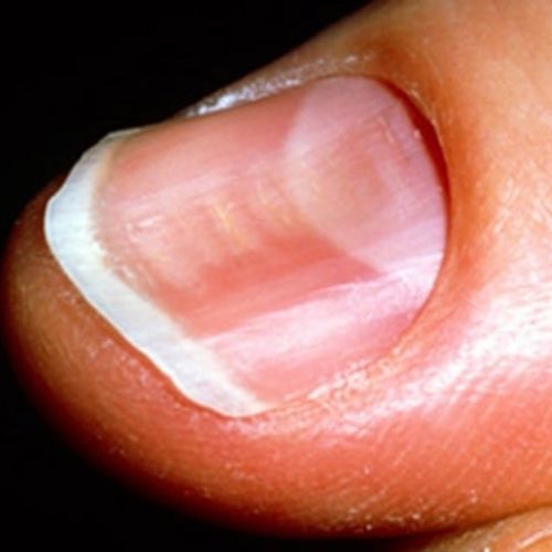 enfermedades que transmiten las uñas