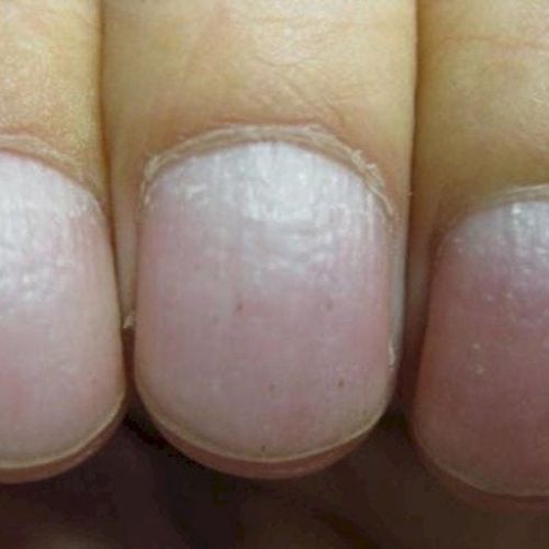 enfermedades que transmiten las uñas