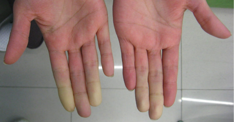 síndrome de Raynaud