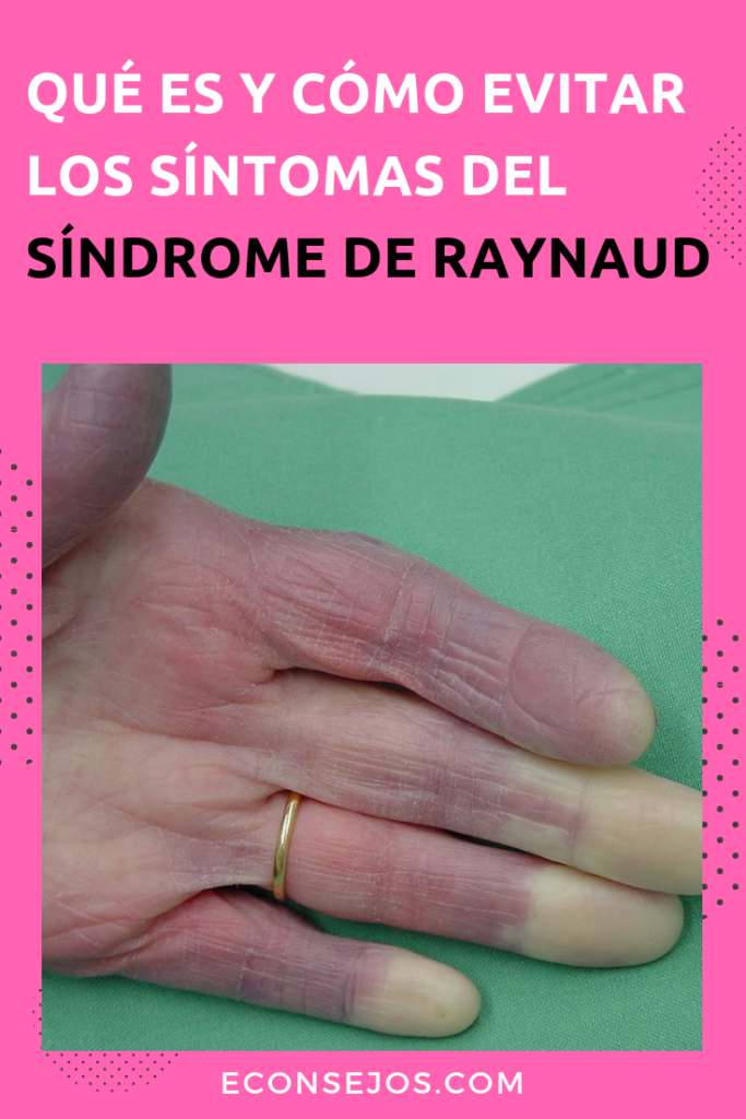 sindrome de reynaud