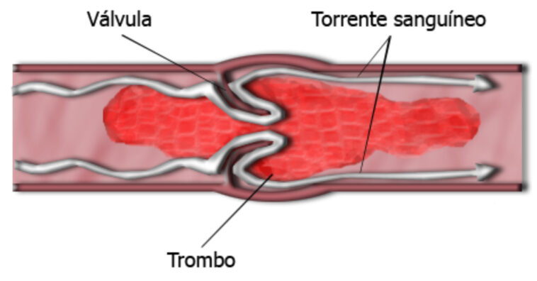 síntomas de una trombosis