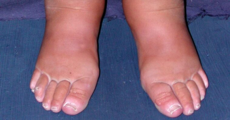 Linfedema