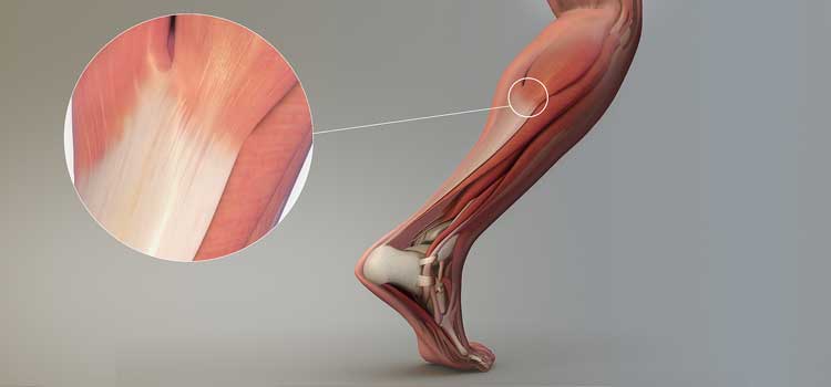 tendinitis sintomas